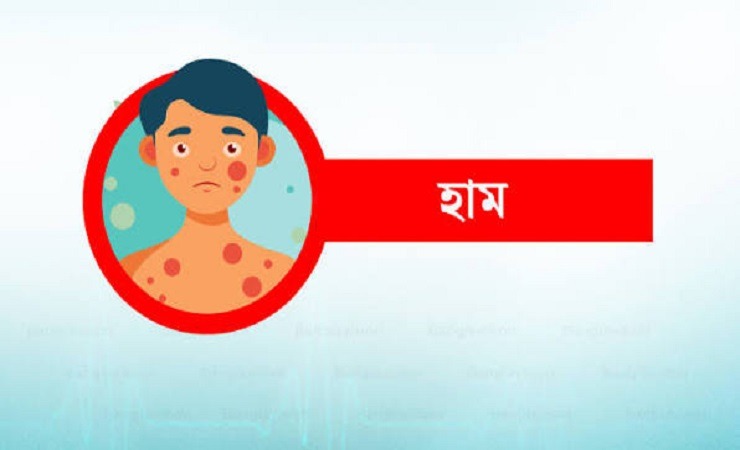 দেশে হামে আরও ৪ শিশুর মৃত্যু
